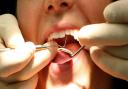 File photo dated 15/09/08 of a dentist at work, as figures show that the number of tooth extractions in hospital for children aged four and under has risen by almost a quarter in the last decade. PRESS ASSOCIATION Photo. Issue date: Tuesday March 21,