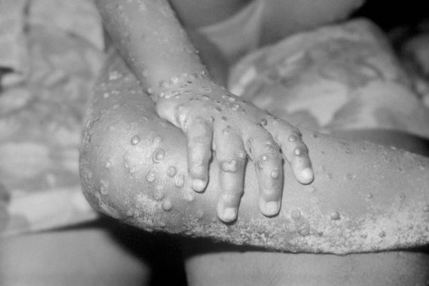 Wandsworth Times:  Eleven more cases of monkeypox have been confirmed in the UK, bringing the total to 20 (Alamy/PA)