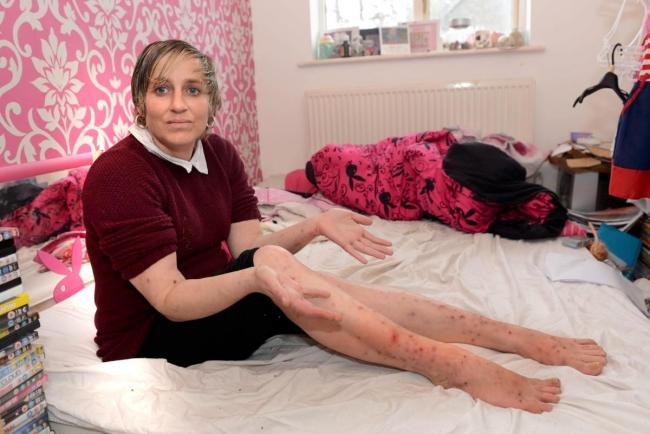 'Living nightmare': single mum Clare Knight reveals her bedbug bites